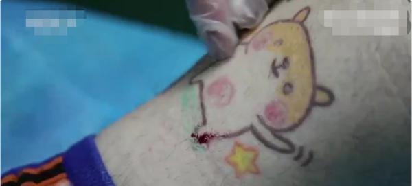 小伙胸口纹文前女友名字,去掉需手术切除!“挺后悔的,疼得刻骨铭心” 小伙胸口纹文前女友名字,去掉需手术切除!“挺后悔的,疼得刻骨铭心”