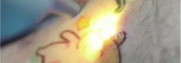 小伙胸口纹文前女友名字,去掉需手术切除!“挺后悔的,疼得刻骨铭心” 小伙胸口纹文前女友名字,去掉需手术切除!“挺后悔的,疼得刻骨铭心”