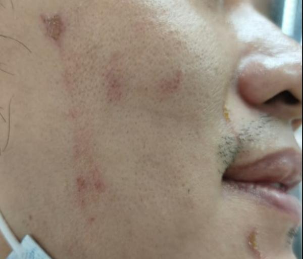 看到脸上有虫，一巴掌拍下去差点毁容了