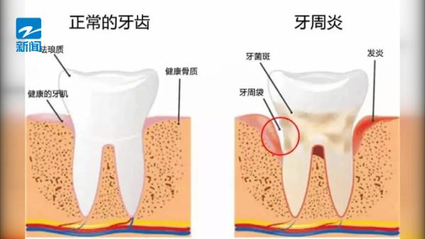 男子40岁牙齿就掉光了！没想到跟这个很多人都有的习惯有关…