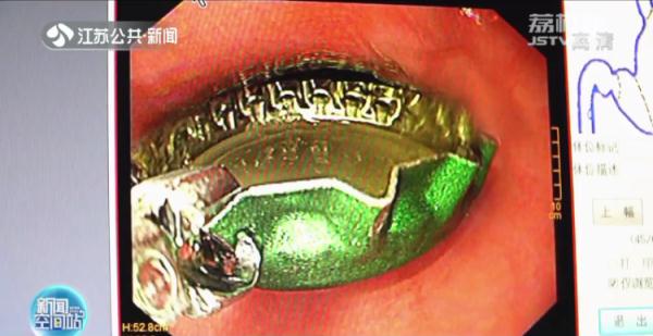 男子喝粥被异物卡喉硬吞馒头咽下，取出后发现竟是……