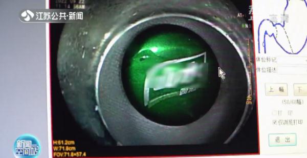 男子喝粥被异物卡喉硬吞馒头咽下，取出后发现竟是……