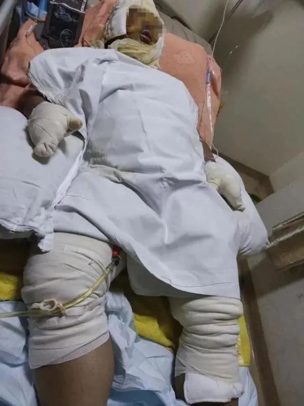 男子蹲马桶,突然炸了!全身80%烧伤!这个行为别不当回事... 男子蹲马桶,突然炸了!全身80%烧伤!这个行为别不当回事...