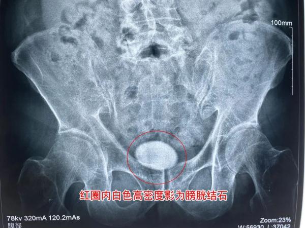 67岁男子出趟远门就要垫尿片, 一查竟是这个毛病 67岁男子出趟远门就要垫尿片, 一查竟是这个毛病