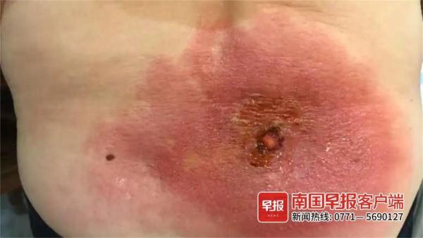 女子做理疗被烫伤，只能趴着睡觉！保健店回应