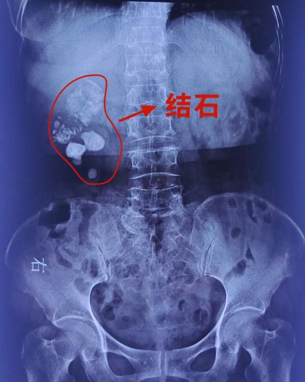 高温天冷得穿棉袄，竟是“结石”在作怪