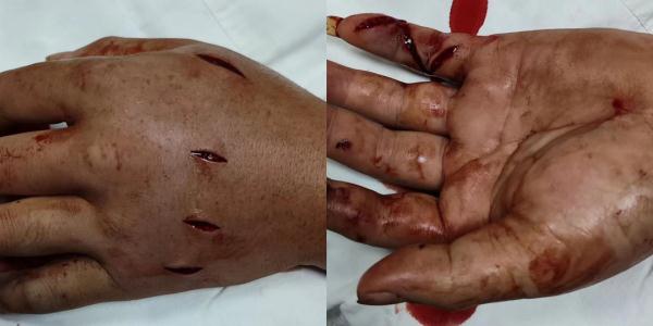 吓人！台州男子露营被蛇咬了一口，整只手肿胀淤青，医院紧急注射8支血清...