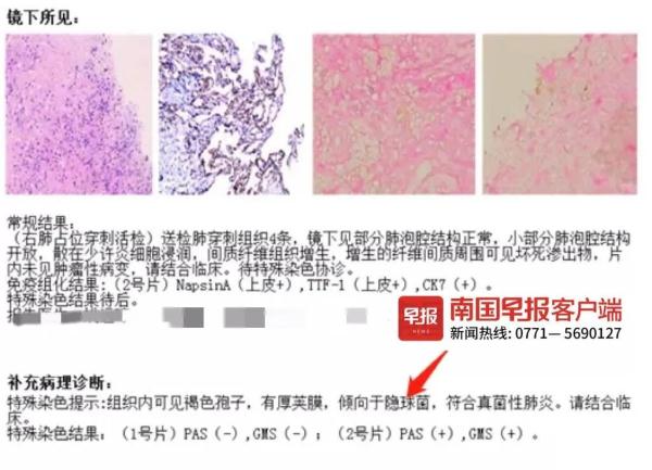 大爷以为患上肺癌,结果一查……诱因或是喂了一次鸽子 大爷以为患上肺癌,结果一查……诱因或是喂了一次鸽子