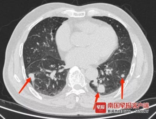 大爷以为患上肺癌,结果一查……诱因或是喂了一次鸽子 大爷以为患上肺癌,结果一查……诱因或是喂了一次鸽子