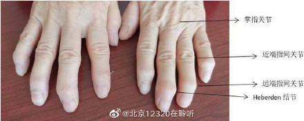 出现手指畸形，可能是类风湿关节炎？还是骨关节炎？