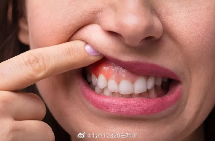 牙龈炎症是青少年常见的口腔疾病,该如何预防?