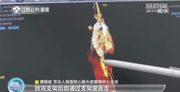女子遭遇车祸，竟导致二氧化碳中毒！怎么回事？