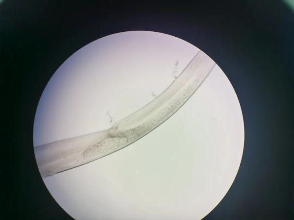 女子眼睛里挑出2厘米蠕动活虫  医生：摸猫狗后请注意手卫生