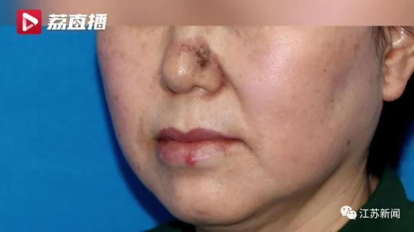 女子鼻头长疙瘩，一直以为是黑头！医生一看：是癌