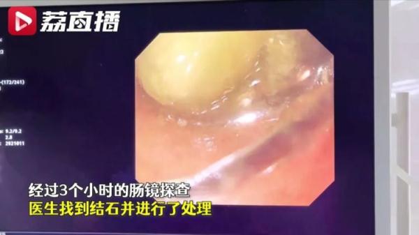 吃完柿子喝酸奶，女子突发肠梗阻！医生：这类人群不宜吃