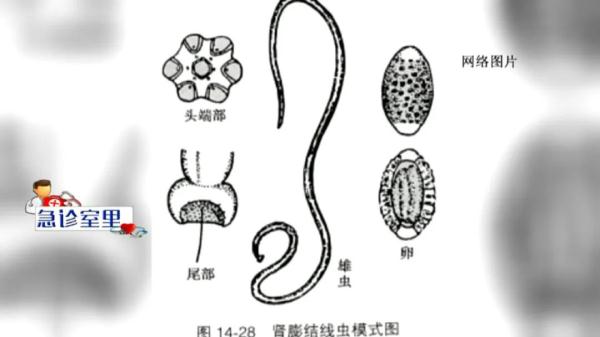 寄生虫侵入肾脏，男子尿液出现虫体，竟是因为……