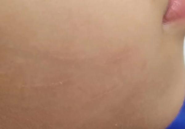 10岁小孩撸猫后反复发烧 身上肿出两大“鸡蛋”......
