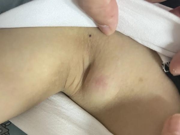 10岁小孩撸猫后反复发烧 身上肿出两大“鸡蛋”......