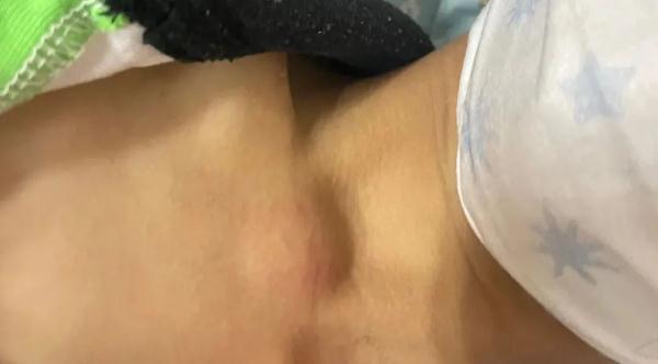10岁小孩撸猫后反复发烧 身上肿出两大“鸡蛋”......