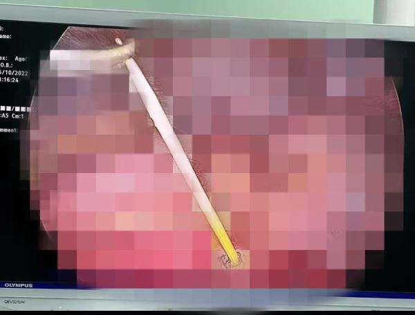 喝酒连它喝进肚，柳州小伙消化道被扎穿！这个动作很多人做过