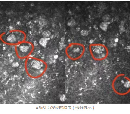 对OK镜卫生护理不当，13岁男孩眼睛感染阿米巴原虫差点视力不保