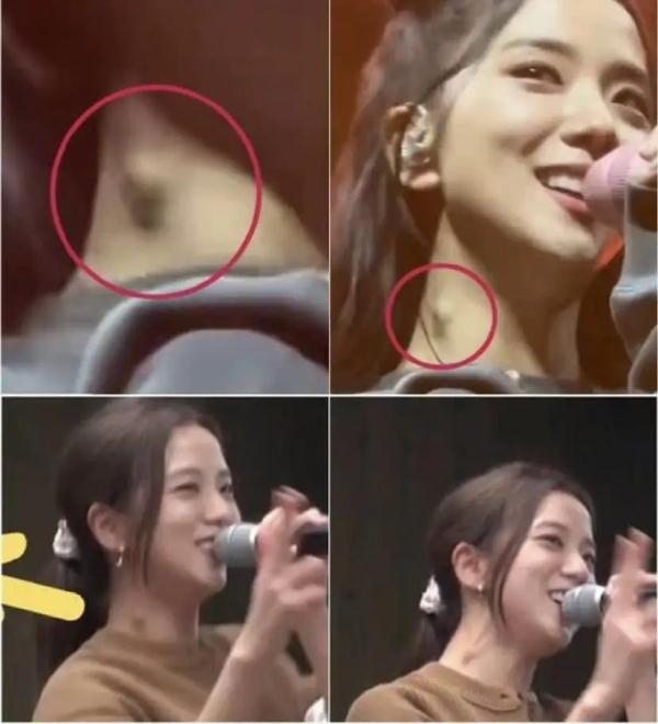 当红女星疑似淋巴结肿大!网友担心:她是不是得了…… 当红女星疑似淋巴结肿大!网友担心:她是不是得了……