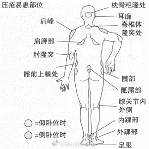 长期卧床的老人如何预防压疮? 长期卧床的老人如何预防压疮?