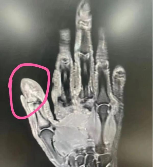 用牙签…爷叔差点手没了！这个习惯很多人都有