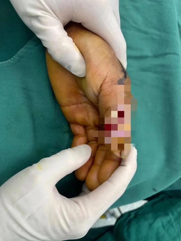 用牙签…爷叔差点手没了！这个习惯很多人都有