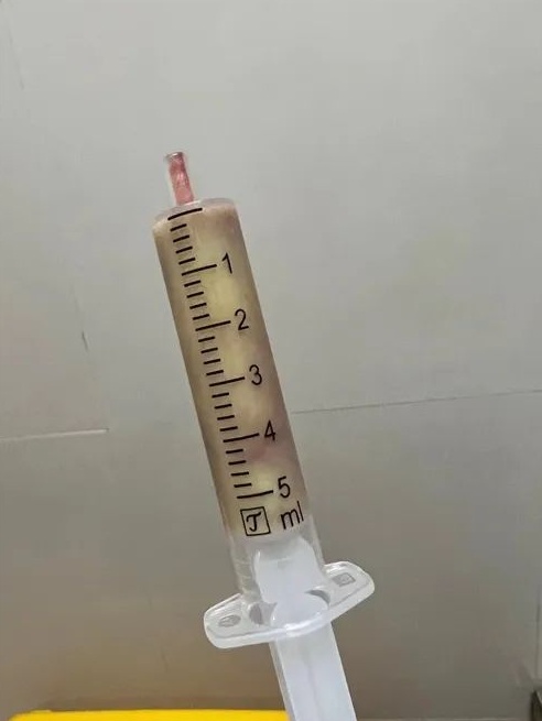 8.8元网购打耳洞神器依教程操作 女孩耳垂肿至半根香蕉大