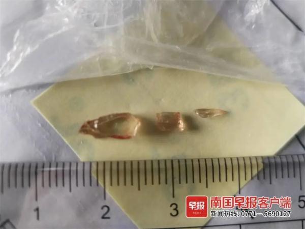 惊险！5岁孩子眼球被玻璃碎片刺穿，好在……