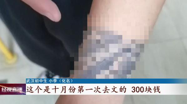图啥!初中生花900元文身,清洗要6万 图啥!初中生花900元文身,清洗要6万