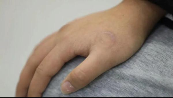 图啥!初中生花900元文身,清洗要6万 图啥!初中生花900元文身,清洗要6万