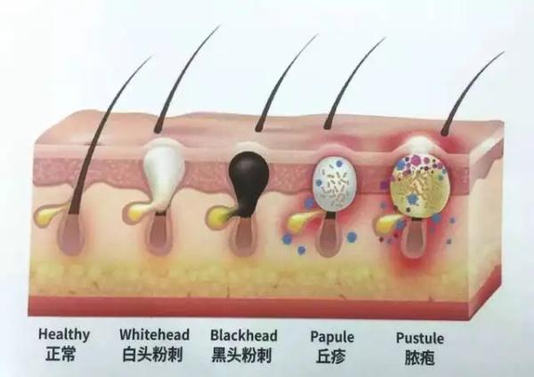 【医聊】拿什么拯救你，我的痘痘肌？