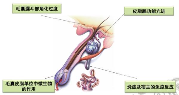 【医聊】拿什么拯救你，我的痘痘肌？