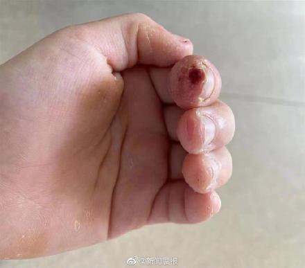 9岁女孩啃手指甲致骨髓炎刮骨疗毒