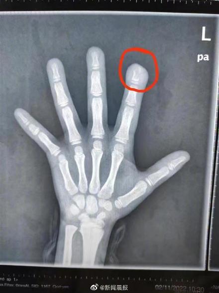 9岁女孩啃手指甲致骨髓炎刮骨疗毒