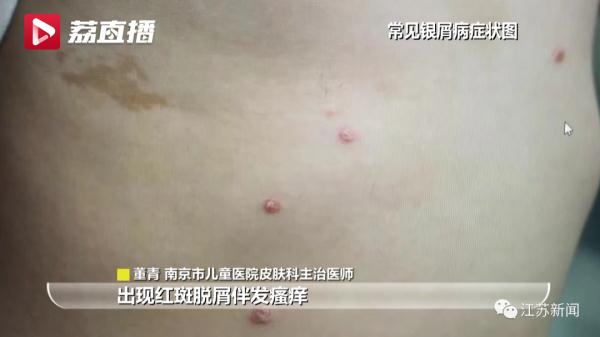 11岁女孩皮肤被涂“敌百虫”,确诊中毒!家长:本是为了治病 11岁女孩皮肤被涂“敌百虫”,确诊中毒!家长:本是为了治病