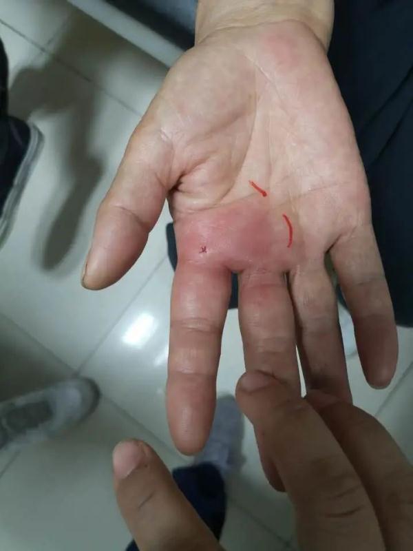 被鱼扎伤了？拍个照先