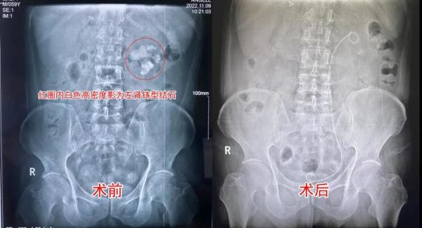 男子患结石三十年不痛不处理,结石野蛮生长如生姜 男子患结石三十年不痛不处理,结石野蛮生长如生姜