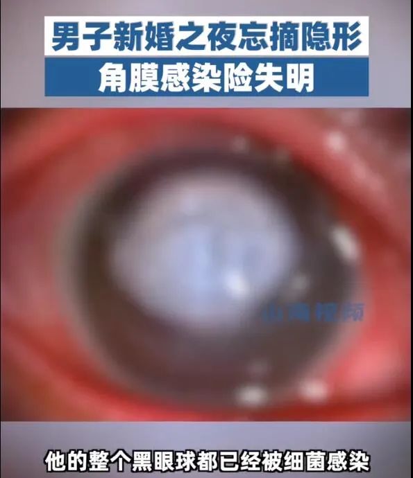 男子新婚夜,眼球变白险失明 男子新婚夜,眼球变白险失明