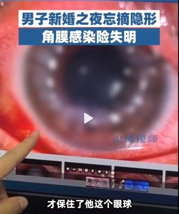 男子新婚夜,眼球变白险失明 男子新婚夜,眼球变白险失明