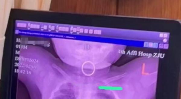 幼童误吞戒指卡喉，医生一招取出！