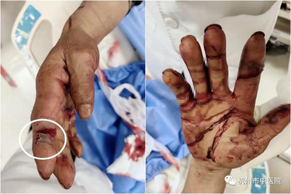 大冬天了还要“来一口”!医生:冬天仍需防蛇 大冬天了还要“来一口”!医生:冬天仍需防蛇