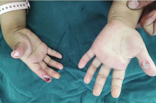 家长请注意！幼童一个动作手被炸黑！