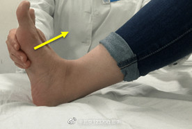 老年人崴脚后，在家如何进行康复锻练？