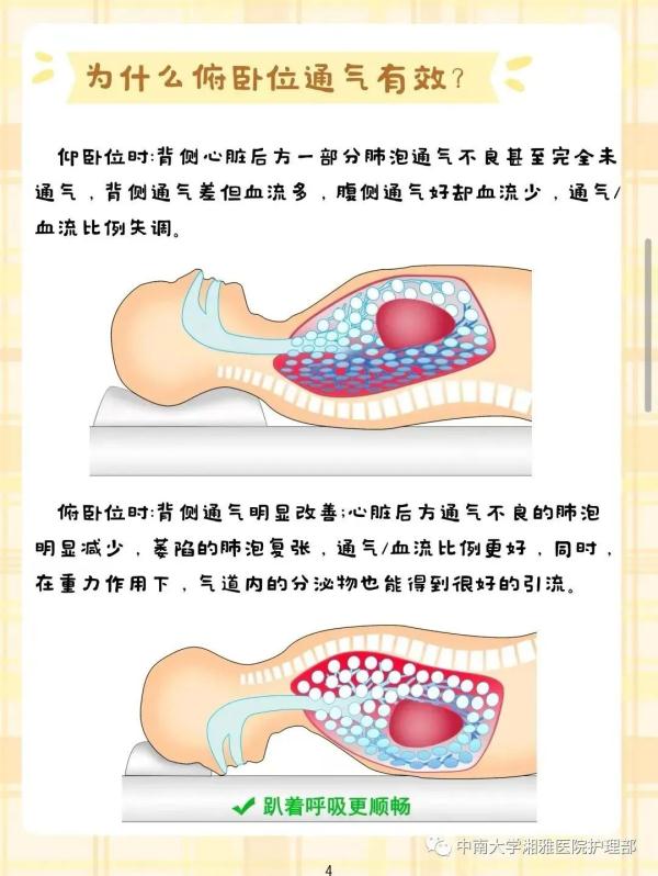 ”趴“着也能治病？！不到5分钟，血氧饱和度由89%上升到了95%