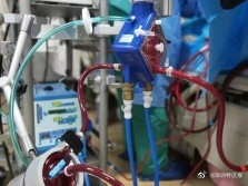 重大突破！深圳制造国产首个ECMO产品获批上市