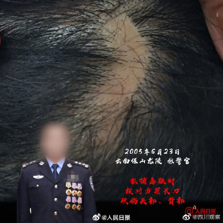 这些禁毒民警的伤疤不能忘！