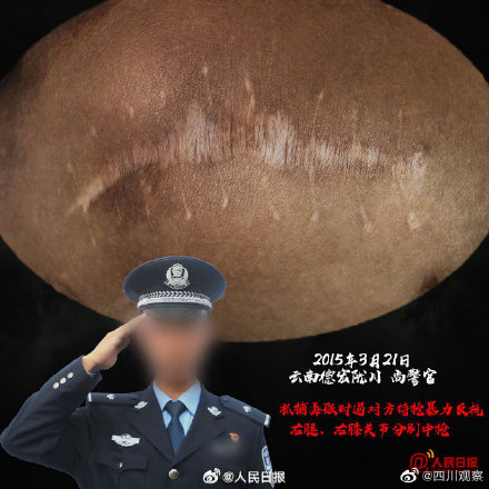 这些禁毒民警的伤疤不能忘！